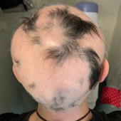 円形脱毛症の治療前｜円形脱毛症の治療結果