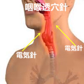 神経 反 麻痺 回 反回神経麻痺｜のどの病気｜分類から調べる｜病気を調べる｜病気解説2600項目｜根拠にもとづく医療情報の提供｜家庭の医学 大全科