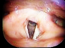 片側声帯麻痺治療前｜片側声帯麻痺の治療結果