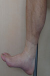 足根管症候群（後脛骨神経炎）の原因｜中国鍼灸治療（整形外科系）