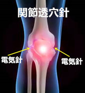 膝関節症の原因｜膝関節症【整形外科疾患】