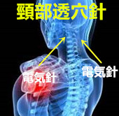 頸椎捻挫の原因｜頸椎捻挫【交通事故】