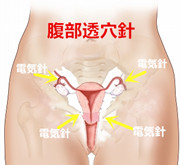 卵巣嚢腫の原因｜卵巣嚢腫【婦人疾患】