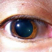 外傷性散瞳の治療前｜外傷性散瞳の治療結果
