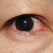 外傷性散瞳の治療｜外傷性散瞳の治療結果