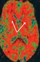 変性 核 症 基底 大脳 大脳皮質基底核変性症について