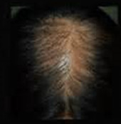粃糠性脱毛症の治療前｜粃糠性脱毛症の治療結果