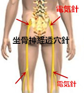 腓骨 神経 麻痺 総